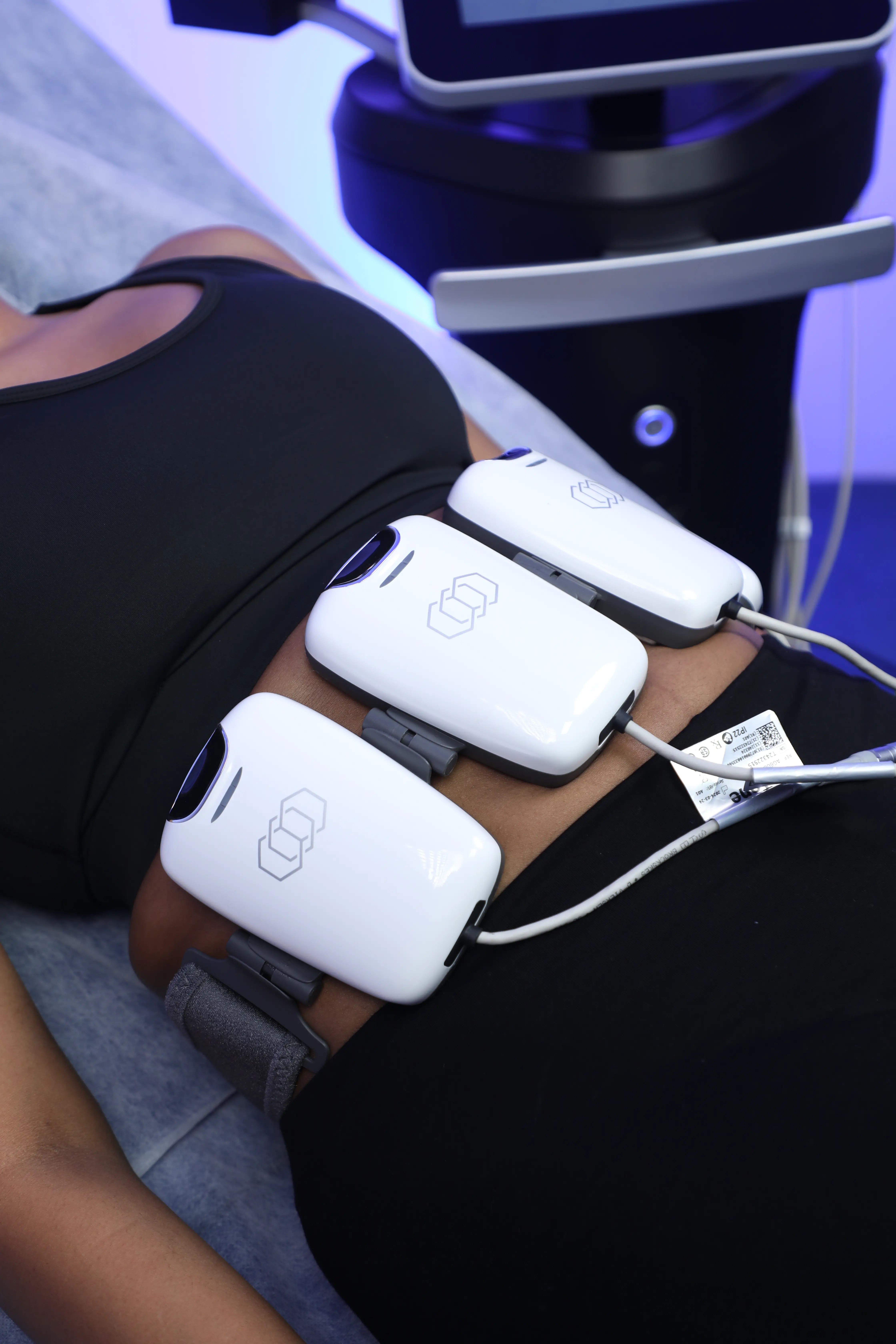 Coolsculpting on stomach