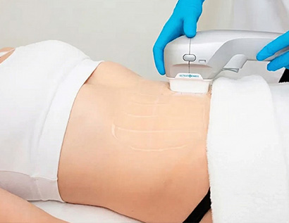 Vecura Resculpt HIFU